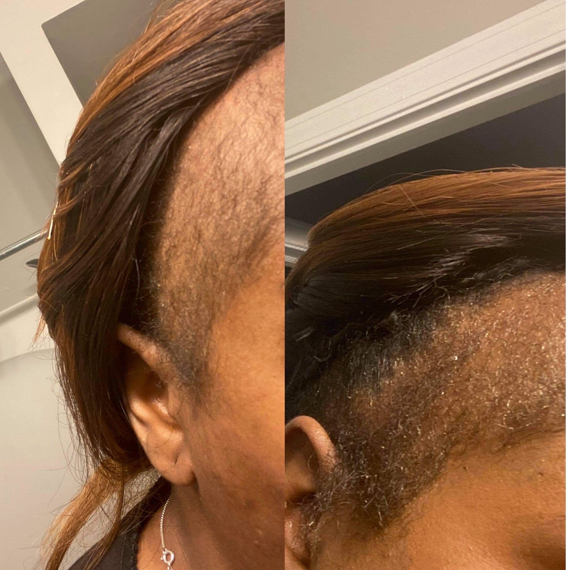 One month results of using Honey Butter.